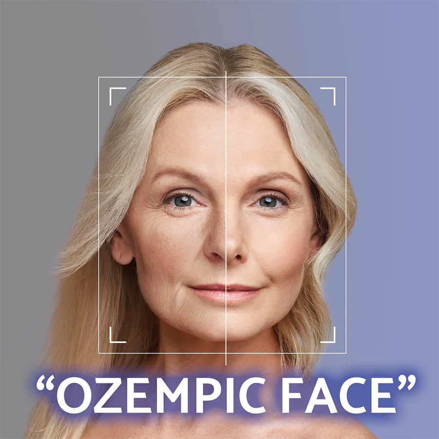 Volumetrická korekcia tvárovej architektúry – návrat mladistvých kontúr bez skalpela Volumetrická korekcia tvárovej architektúry – návrat mladistvých kontúr bez skalpela